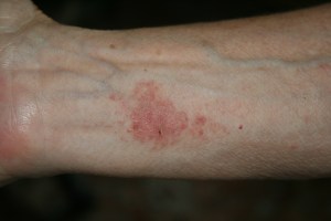 Week old brown recluse spider bite